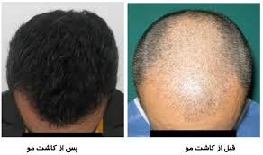 روش های درمانی موثر برای ریزش مو