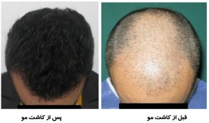 سرعت بخشیدن به رشد مو بعد از کاشت مو
