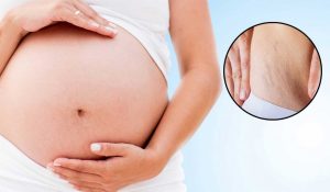 چگونه از ایجاد ترک ها ی حاملگی جلوگیری کنیم؟