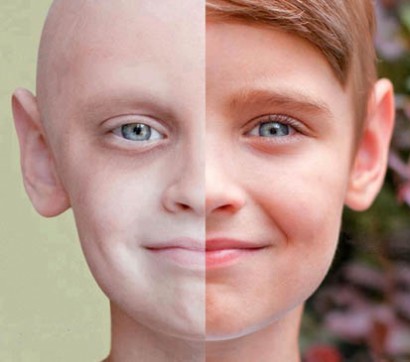 سرطان پوست : شایع ترین سرطان بدخیم بدن است!