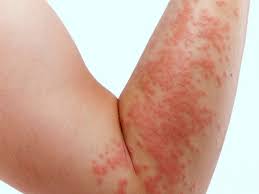 کهیر: شایع ترین علامت پوستی در حساسیت های دارویی!