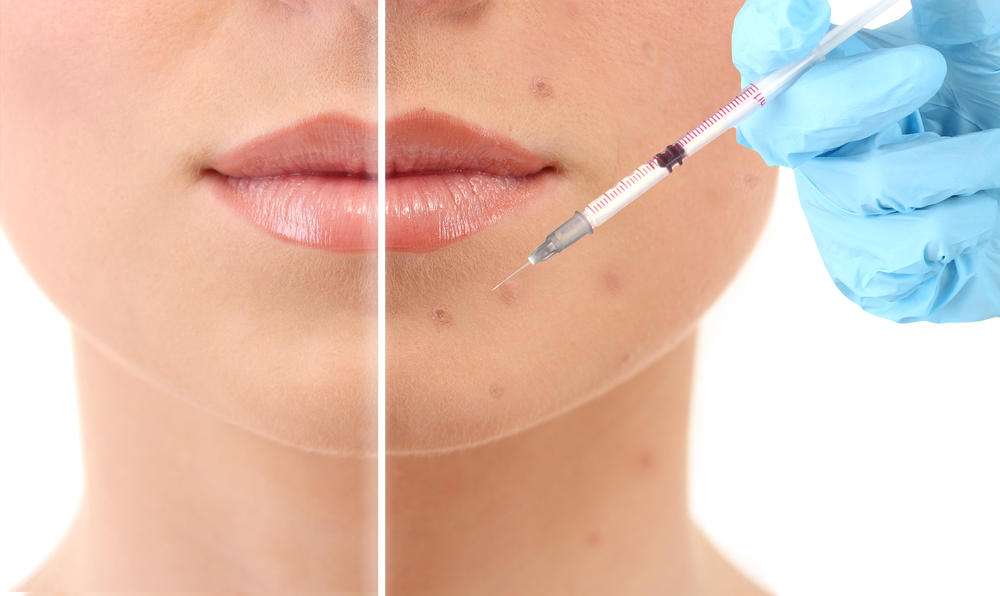 Milford CT PRP Injection for Acne Scars - درمان جوش و جای جوش با پی آر پی (PRP)