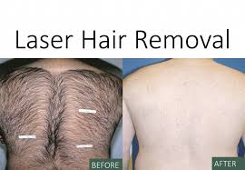 images 3 - لیزر موهای زائد آقایان! خانم ها از جمع کردن مو خسته شده اید !؟