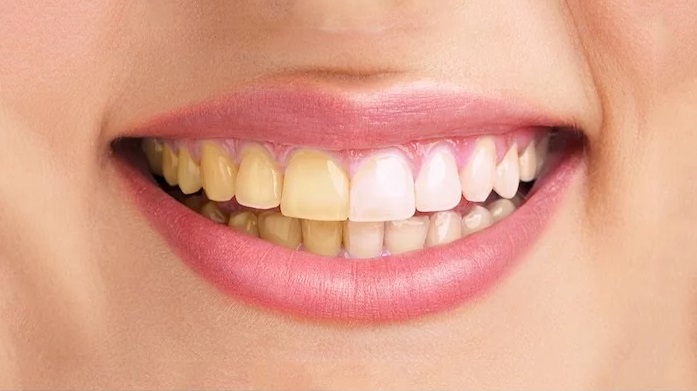 زردی دندان ها - علت زردی دندان چیست؟راه های درمان کدامند!
