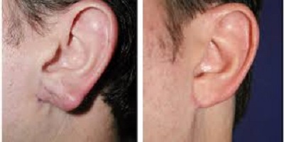 1 - جراحی  زیبایی گوش - آیا جراحی گوش بر  میزان زیبایی شما موثر است ؟