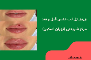 تزریق ژل لب عکس قبل و بعد