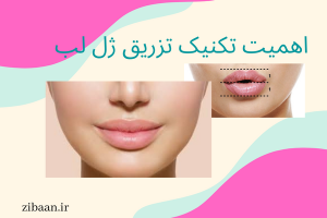 بهترین تکنیک تزریق ژل لب