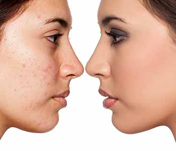 درمان اسکار صورت با دستگاه فیس آپ
