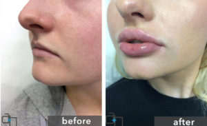بعد از تزریق ژل لب چه نکاتی را باید رعایت کرد
