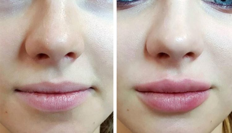 types_of_lip_fillers