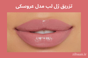 تزریق ژل لب مدل عروسکی باربی