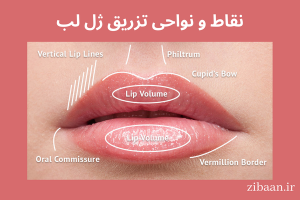 نقاط و نواحی تزریق ژل لب
