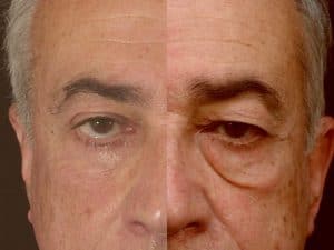 بلفاروپلاستی هزینه