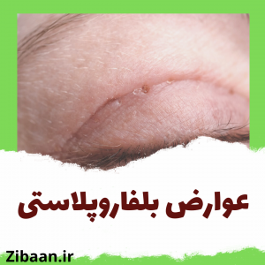 عوارض بلفاروپلاستی