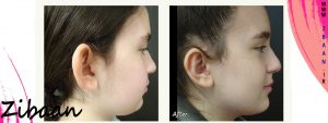 جراحی زیبایی گوش