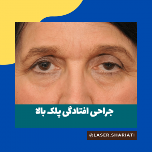 قیمت جراحی پلک در تهران