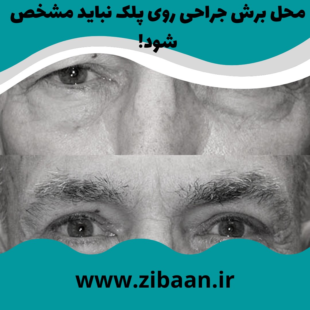 تشخیص جراح پلک خوب در تهران