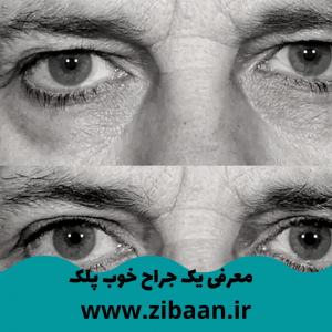 هزینه عمل افتادگی پلک