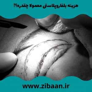 بهترین دکتر بلفاروپلاستی