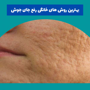 سریع ترین راه رفع جای جوش