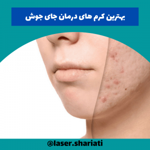 سریع ترین راه رفع جای جوش
