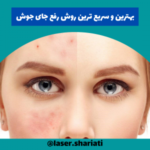سریع ترین راه رفع جای جوش