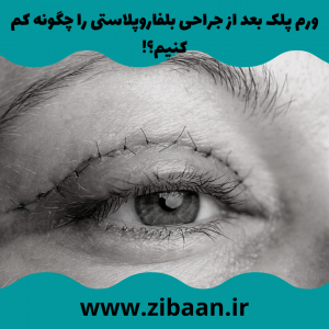 مراقبت بعد از عمل بلفاروپلاستی