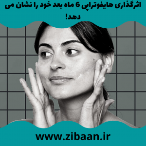 جوانسازی صورت در یک جلسه با هایفو