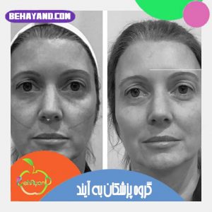 بوتاکس بهتر است یا لیفت با نخ