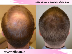 نتایج تزریق هیر فیلر مو