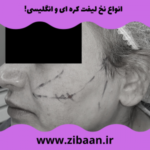 هزینه لیفت با نخ کره ای
