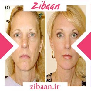 سریع ترین راه جوانسازی پوست