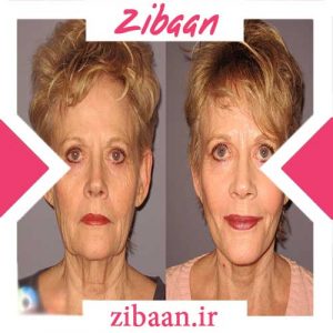 سریع ترین راه جوانسازی پوست