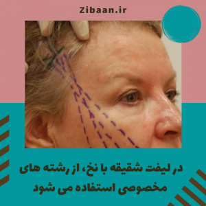 قیمت لیفت شقیقه با نخ مخصوص