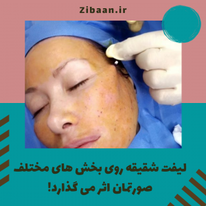 قیمت لیفت شقیقه با نخ
