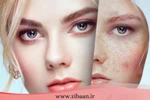 مزوتراپی صورت برای لک