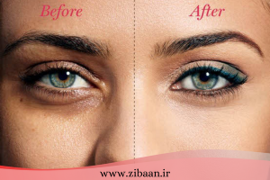 مزوتراپی دور چشم