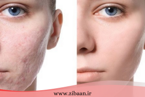 عکس قبل و بعد از مزوتراپی صورت