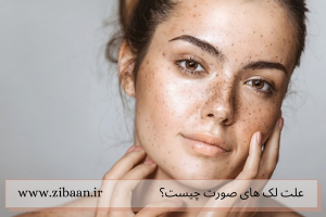 علت لکه های قهوه ای روی صورت