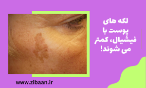 فیشیال پوست صورت برای لکه ها